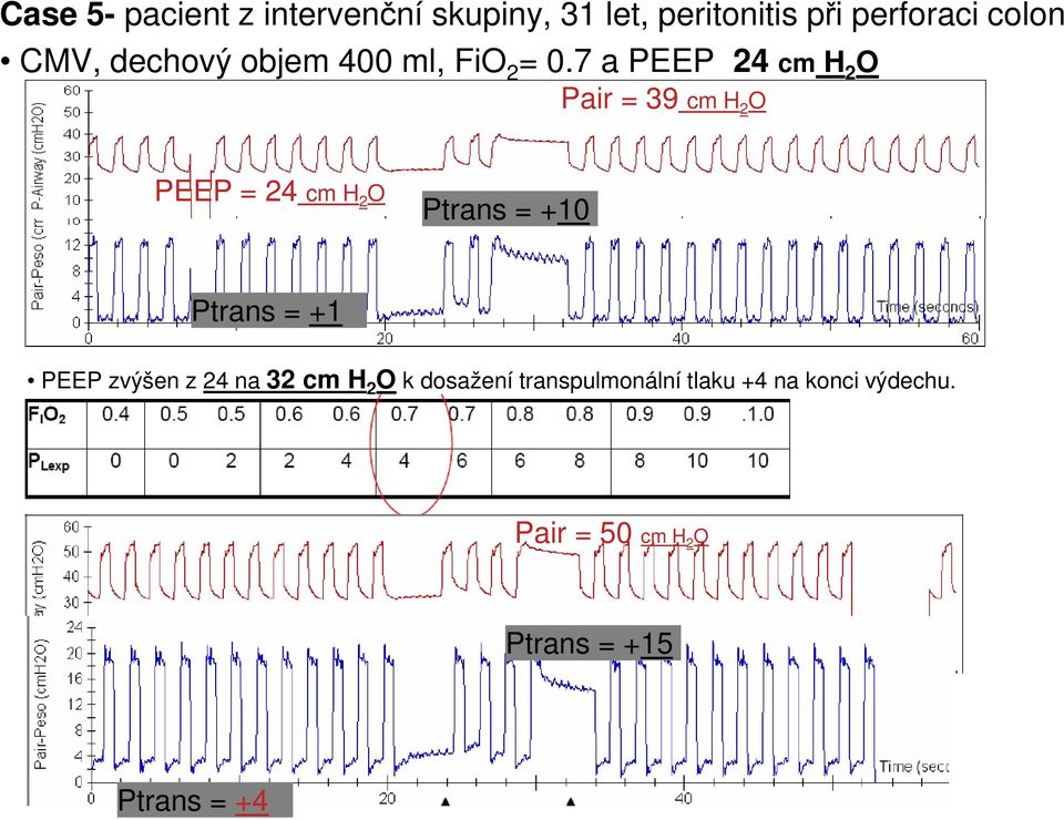 7 a PEEP 24 cm H 2 O Pair = 39 cm H 2 O PEEP = 24 cm H 2 O Ptrans = +10 Ptrans = +1