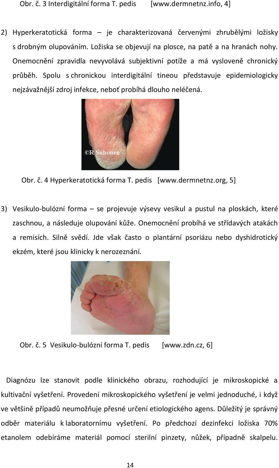 Spolu s chronickou interdigitální tineou představuje epidemiologicky nejzávažnější zdroj infekce, neboť probíhá dlouho neléčená. Obr. č. 4 Hyperkeratotická forma T. pedis [www.dermnetnz.