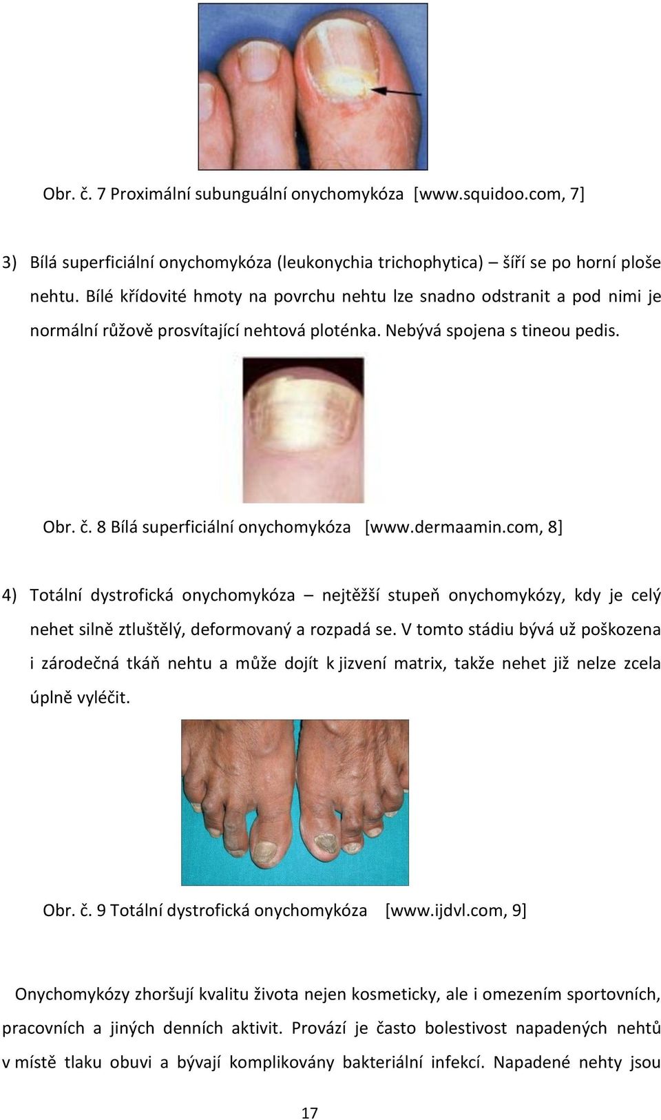 dermaamin.com, 8] 4) Totální dystrofická onychomykóza nejtěžší stupeň onychomykózy, kdy je celý nehet silně ztluštělý, deformovaný a rozpadá se.