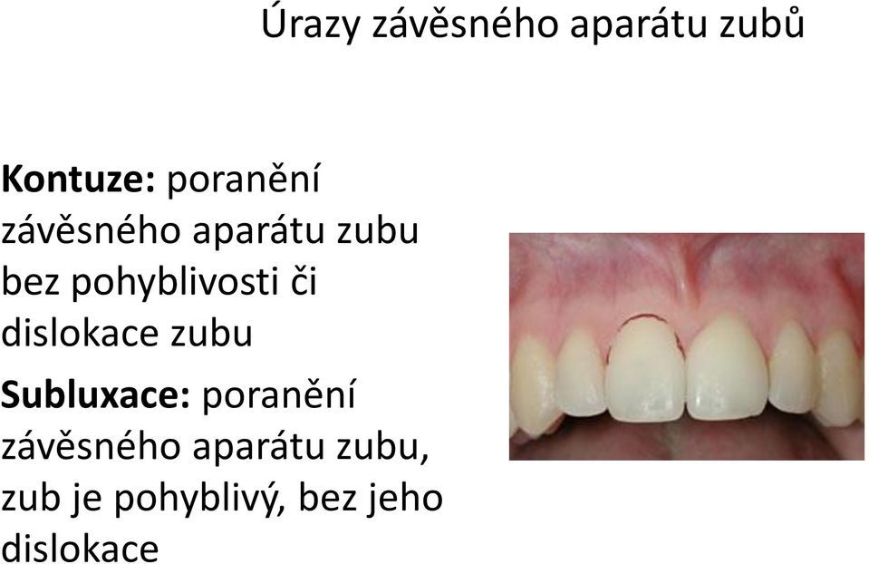 dislokace zubu Subluxace: poranění závěsného