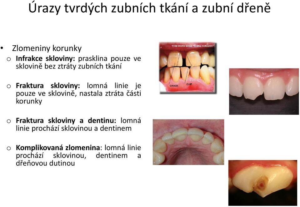 sklovině, nastala ztráta části korunky o Fraktura skloviny a dentinu: lomná linie prochází