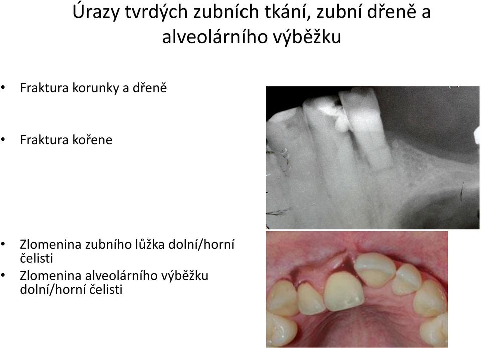 Fraktura kořene Zlomenina zubního lůžka