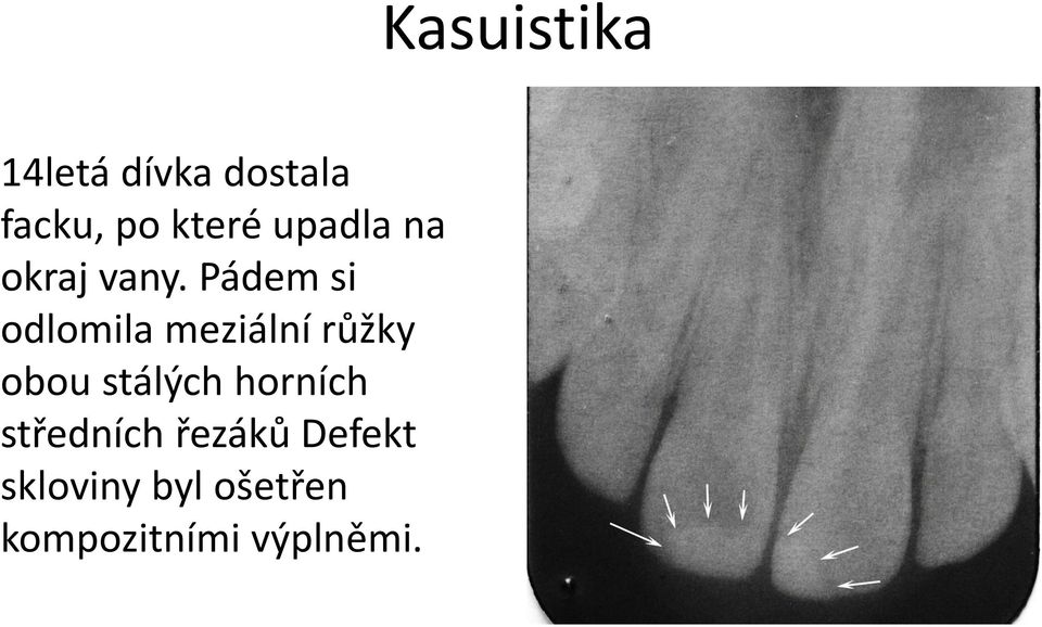 Pádem si odlomila meziální růžky obou stálých