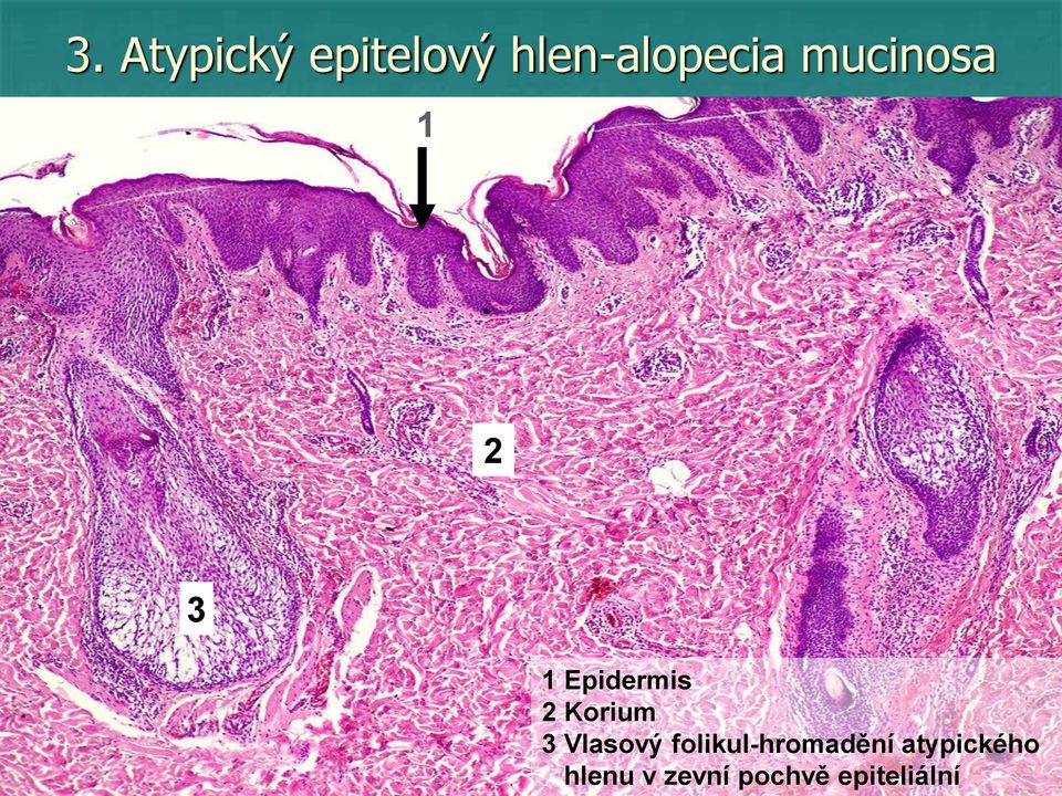 Epidermis Korium 3 Vlasový