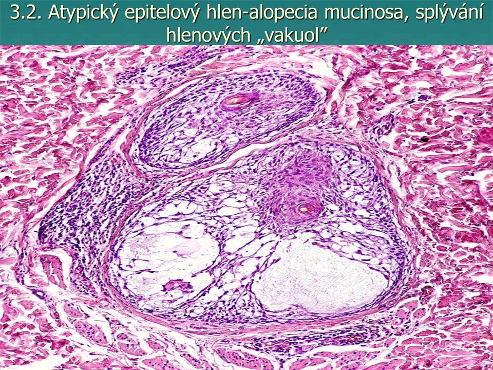 hlen-alopecia