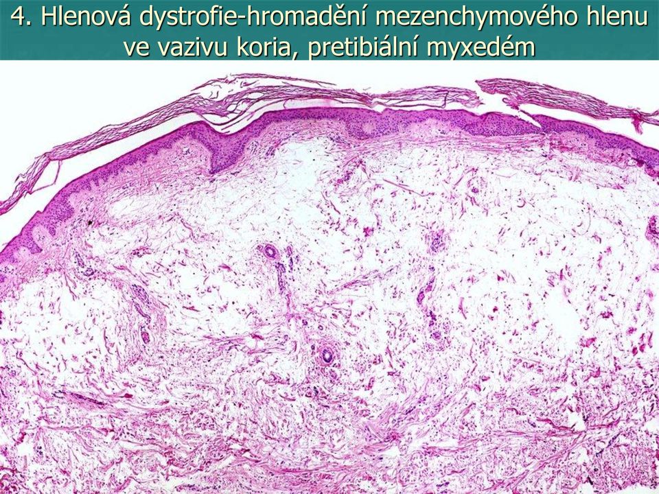 mezenchymového hlenu