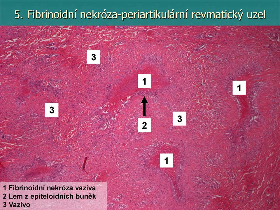 revmatický uzel 3 3 3