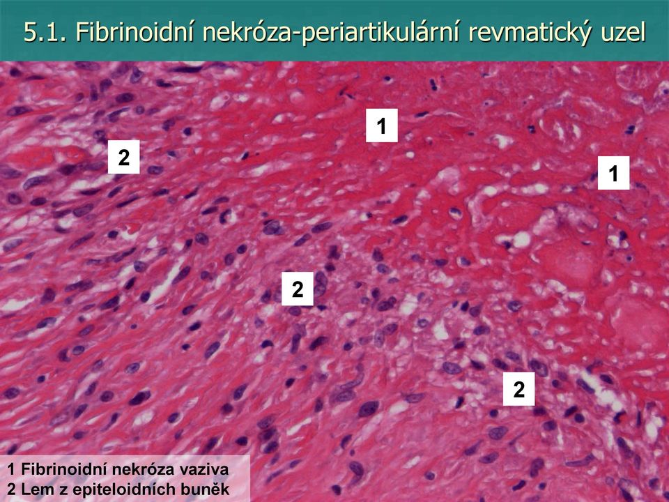 revmatický uzel