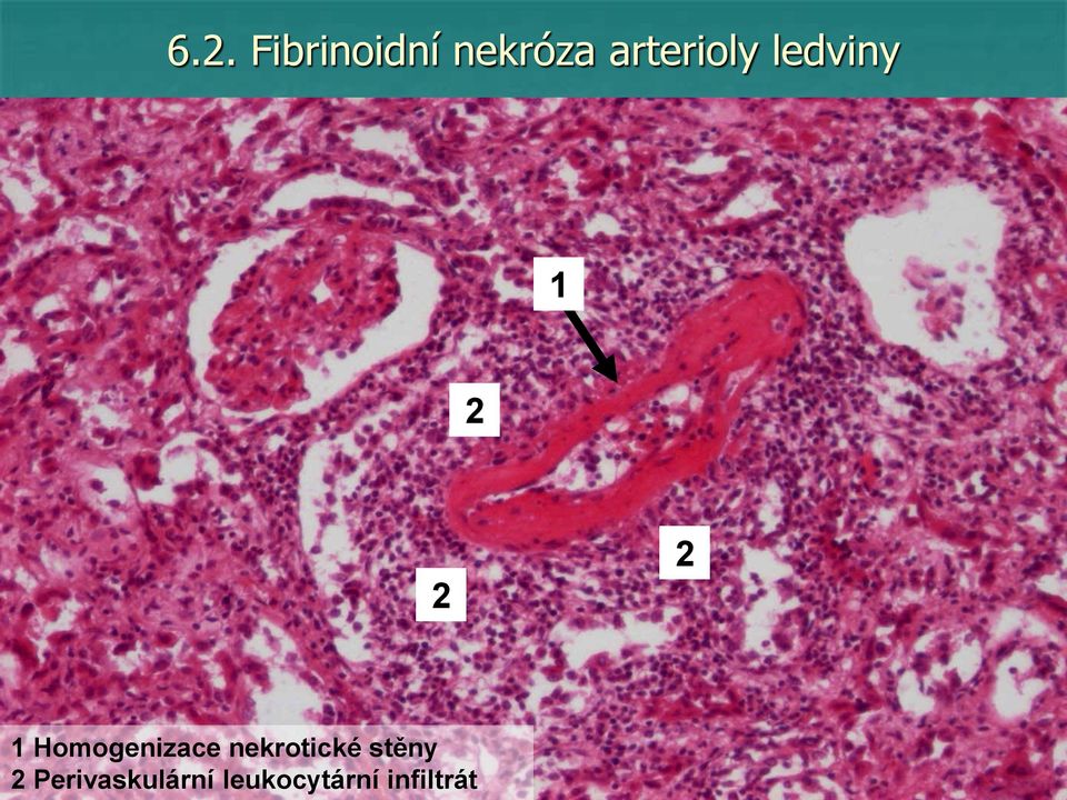 Homogenizace nekrotické