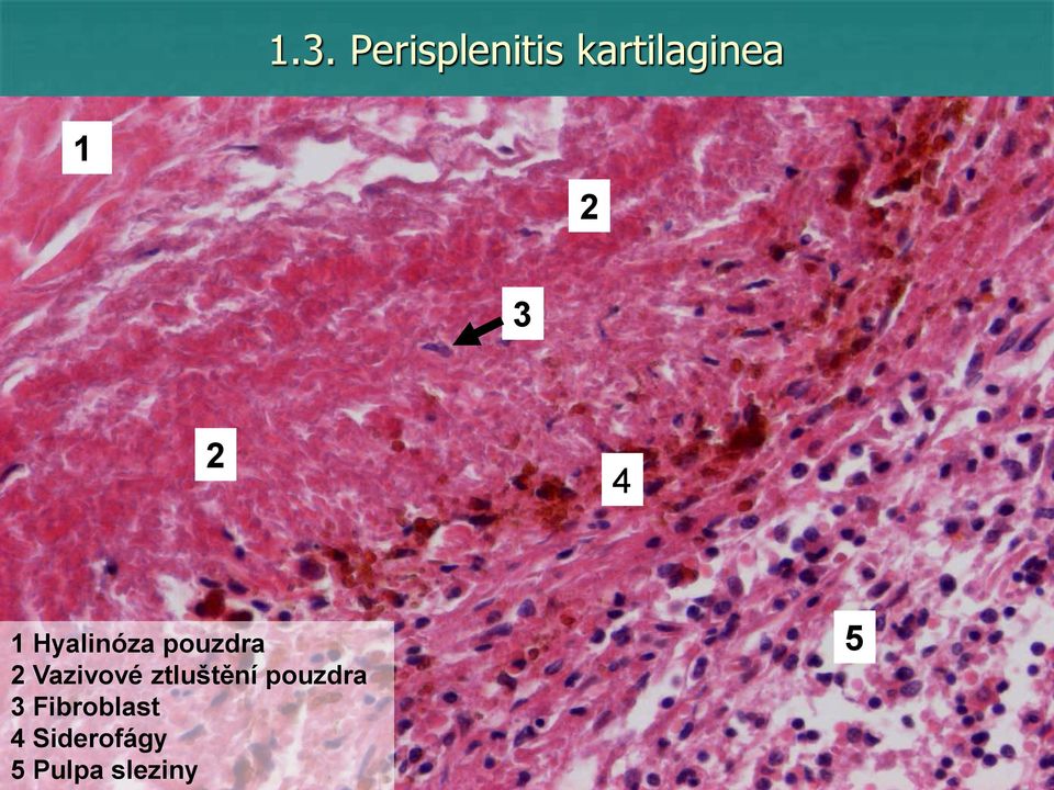 ztluštění pouzdra 3 Fibroblast