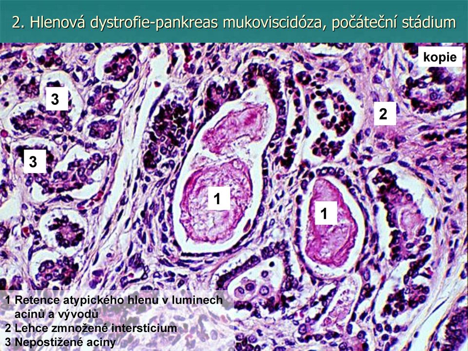 Retence atypického hlenu v luminech acinů