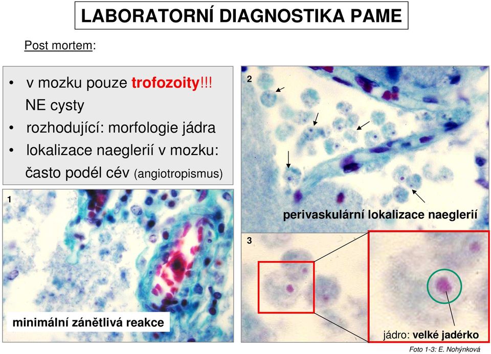 mozku: 2 často podél cév (angiotropismus) 1 perivaskulární lokalizace