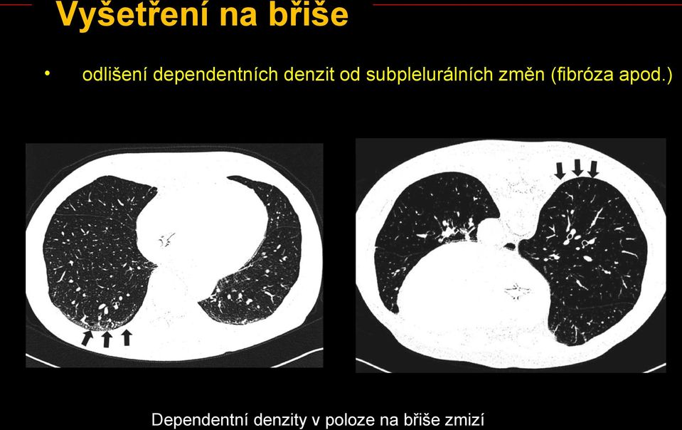 subplelurálních změn (fibróza