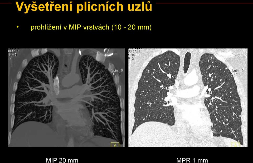 MIP vrstvách (10-20