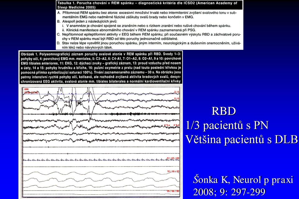 DLB Šonka K, Neurol p