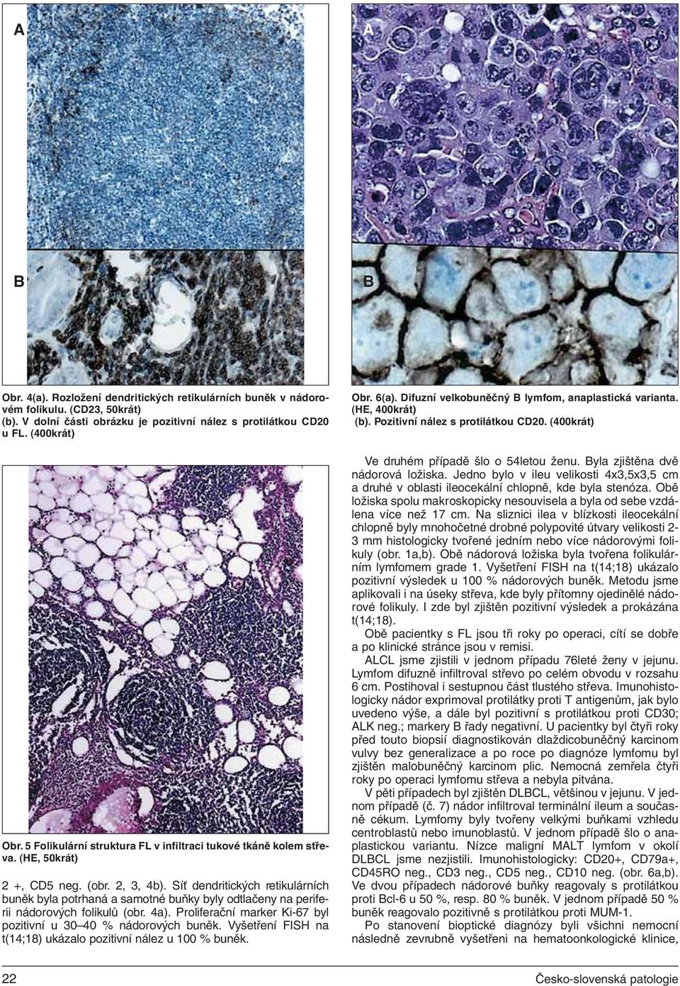 Síť dendritických retikulárních buněk byla potrhaná a samotné buňky byly odtlačeny na periferii nádorových folikulů (obr. 4a). Proliferační marker Ki-67 byl pozitivní u 30 40 % nádorových buněk.