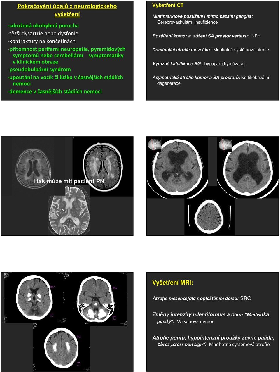 bazální ganglia: Cerebrovaskulární insuficience Rozšíření komor a zúžení SA prostor vertexu: NPH Dominující atrofie mozečku : Mnohotná systémová atrofie Výrazné kalcifikace BG : hypoparathyreóza aj.