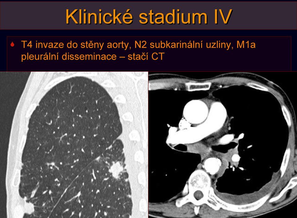 subkarinální uzliny, M1a