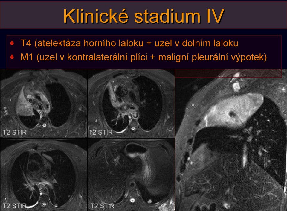 v dolním laloku M1 (uzel v