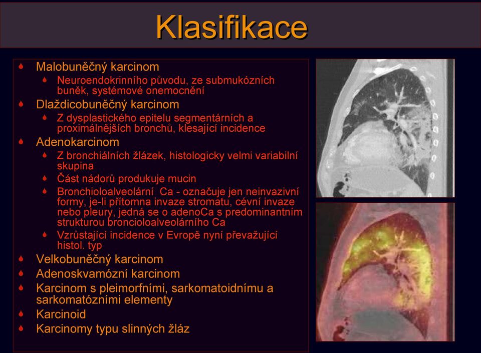 označuje jen neinvazivní formy, je-li přítomna invaze stromatu, cévní invaze nebo pleury, jedná se o adenoca s predominantním strukturou broncioloalveolárního Ca Vzrůstající