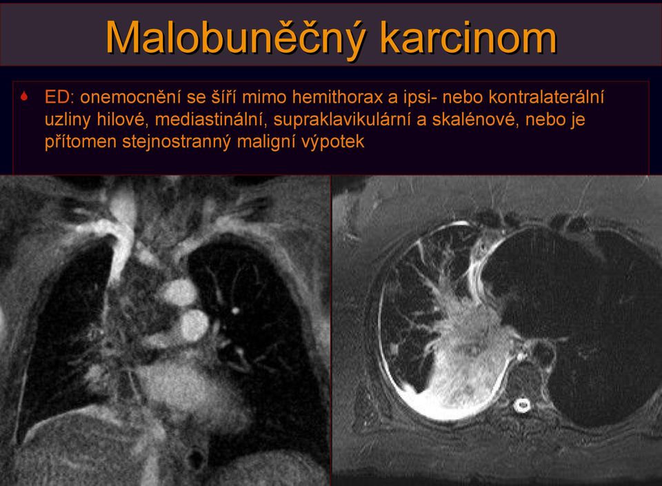 hilové, mediastinální, supraklavikulární a