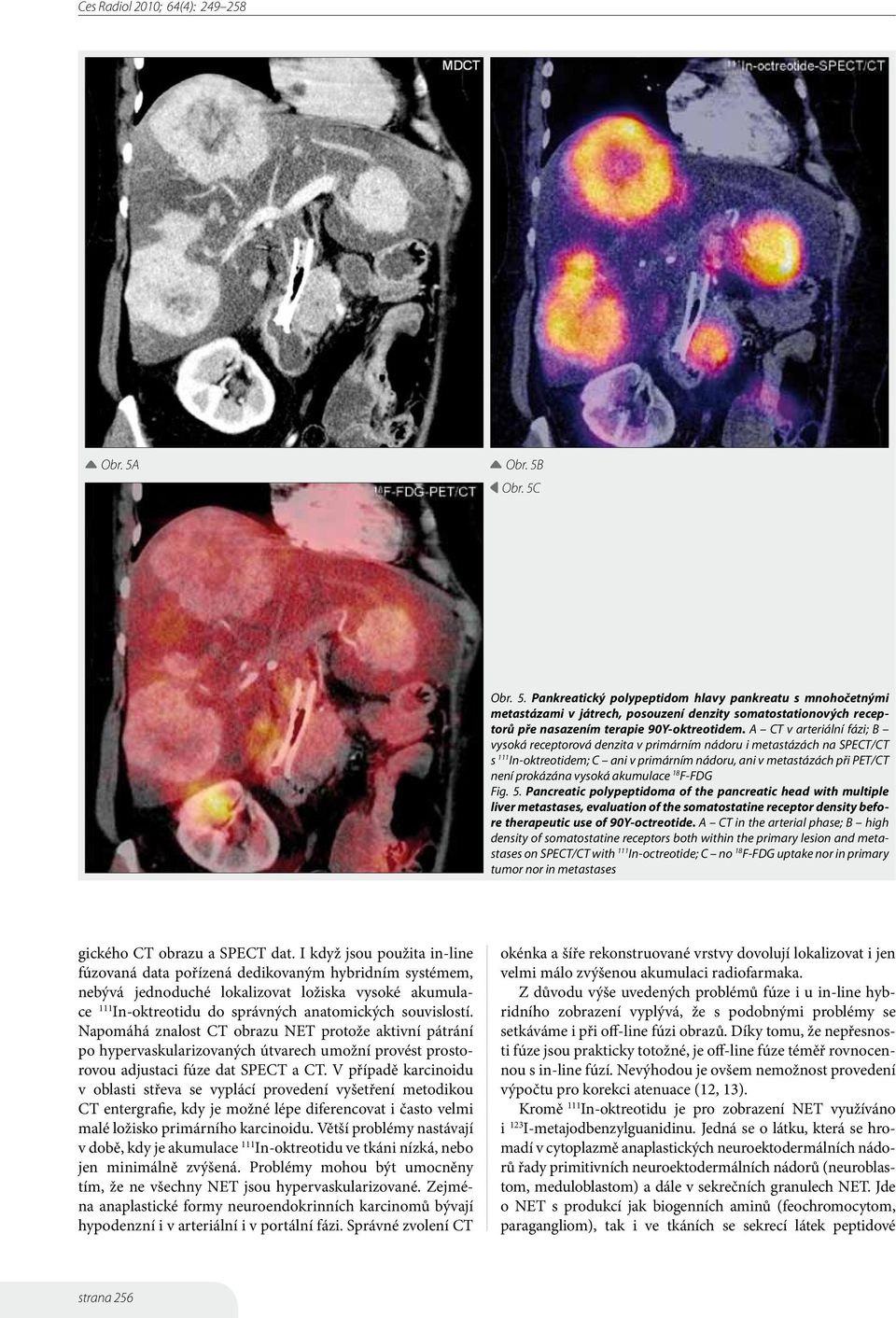 akumulace 18 F-FDG Fig. 5. Pancreatic polypeptidoma of the pancreatic head with multiple liver metastases, evaluation of the somatostatine receptor density before therapeutic use of 90Y-octreotide.