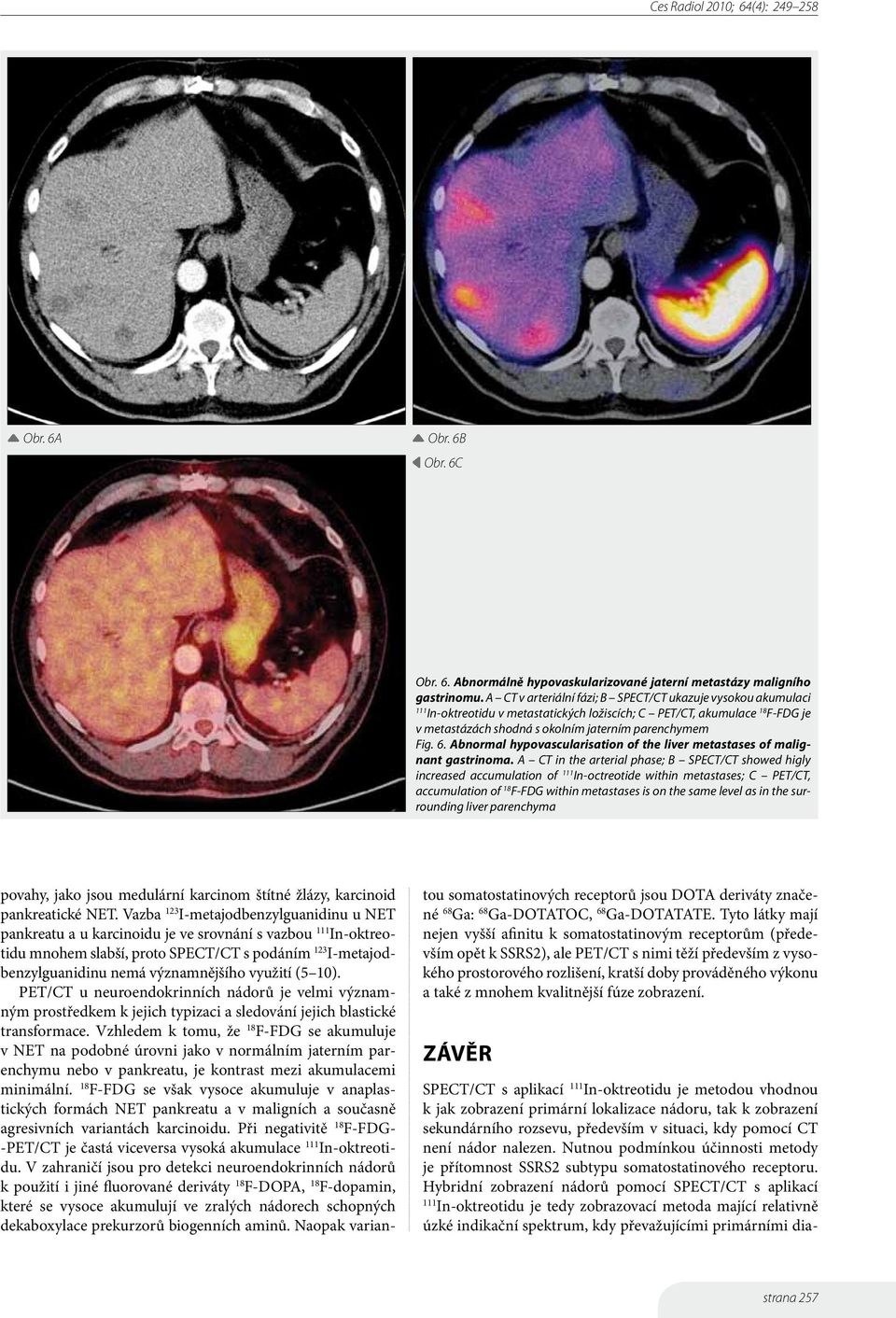 Abnormal hypovascularisation of the liver metastases of malignant gastrinoma.