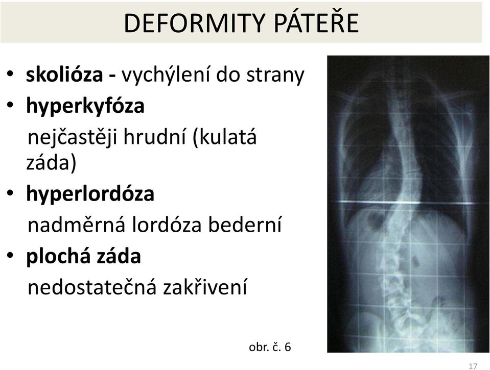 záda) hyperlordóza nadměrná lordóza bederní