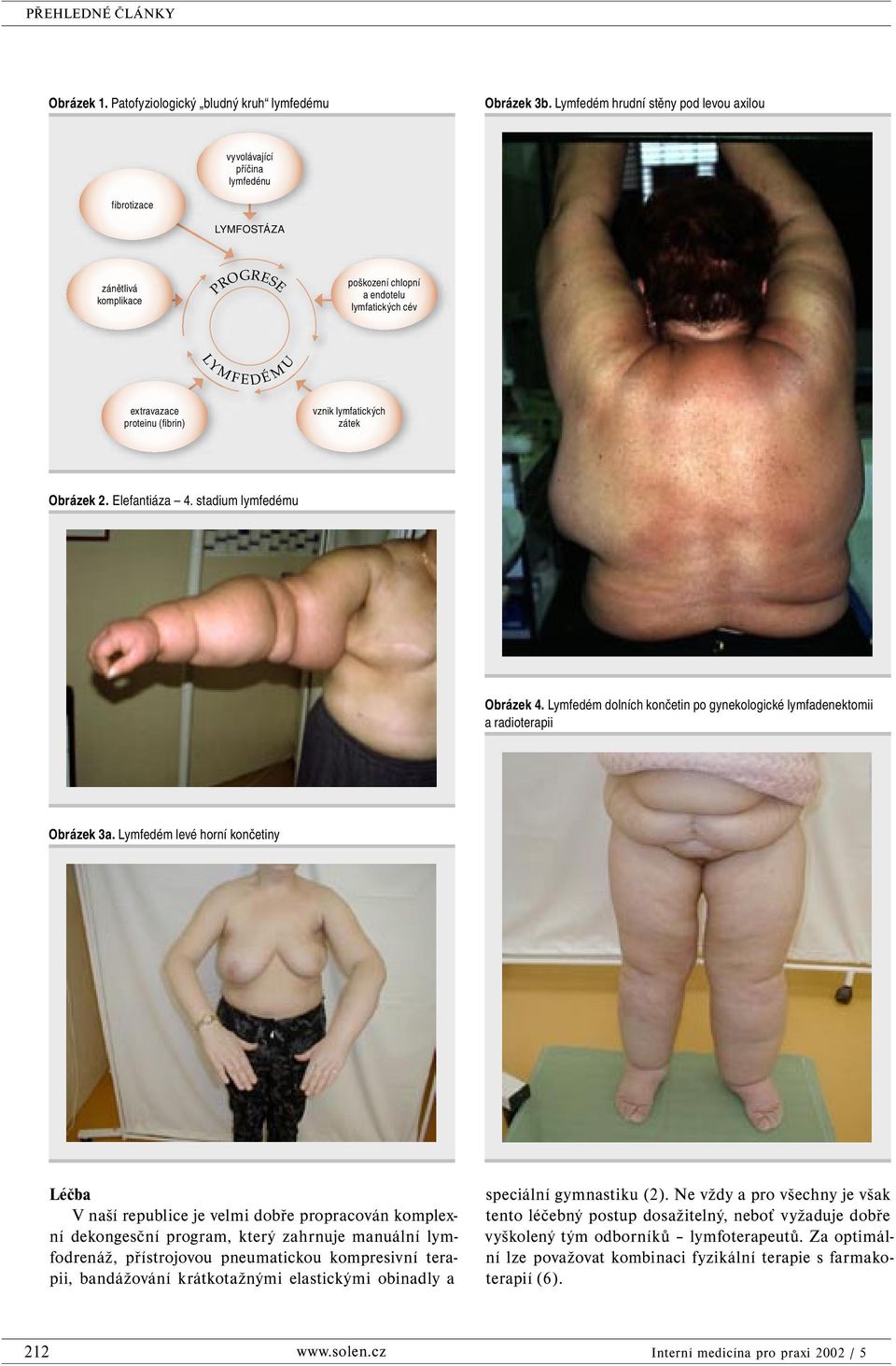 proteinu (fibrin) vznik lymfatických zátek Obrázek 2. Elefantiáza 4. stadium lymfedému Obrázek 4. Lymfedém dolních končetin po gynekologické lymfadenektomii a radioterapii Obrázek 3a.