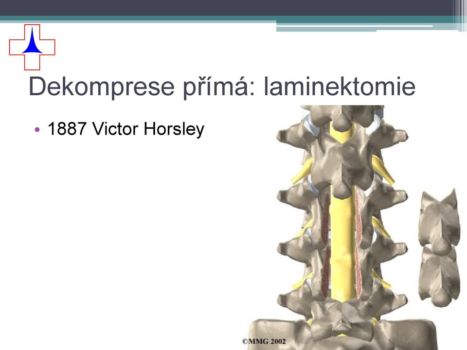 laminektomie