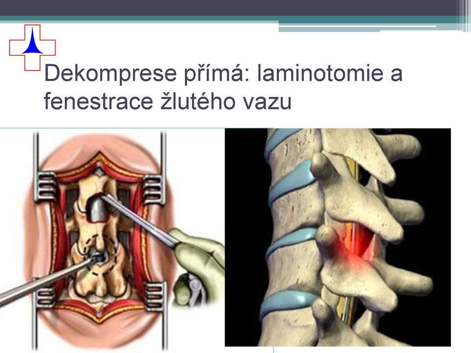 laminotomie a