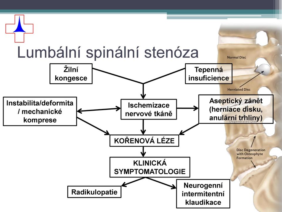 tkáně Aseptický zánět (herniace disku, anulární trhliny) KOŘENOVÁ