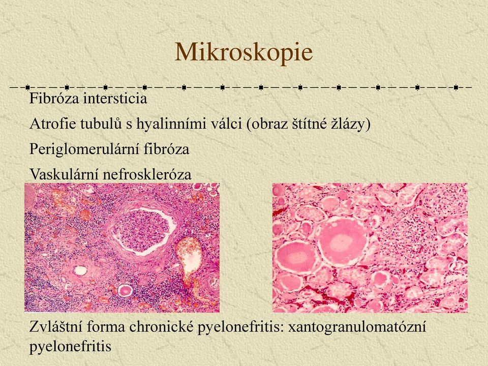 Periglomerulární fibróza Vaskulární nefroskleróza