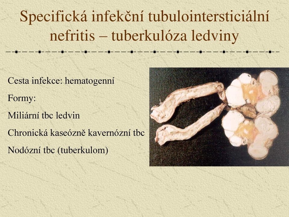 hematogenní Formy: Miliární tbc ledvin