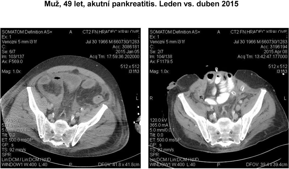 pankreatitis.