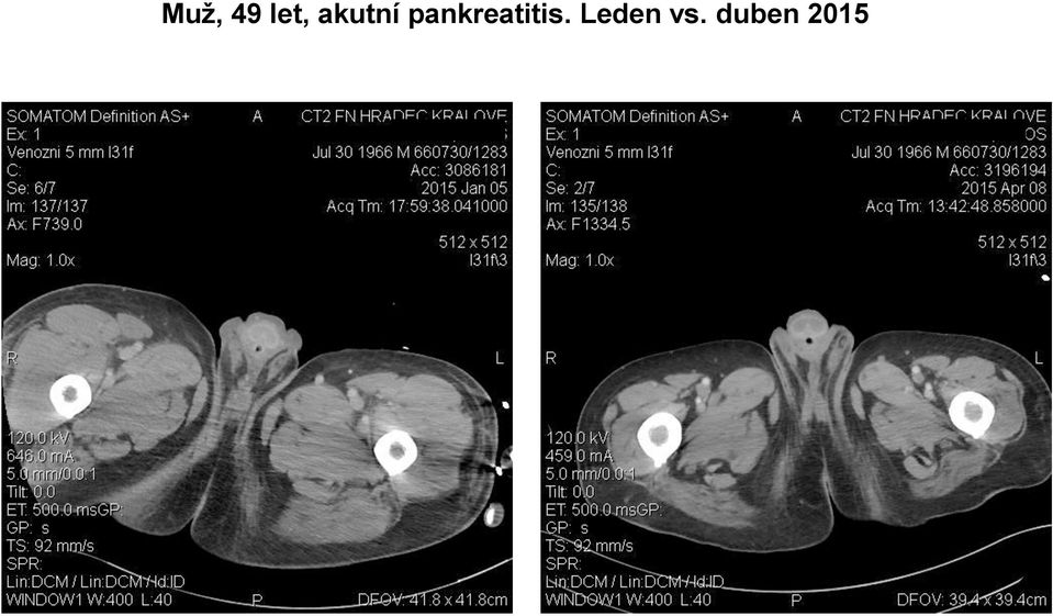 pankreatitis.