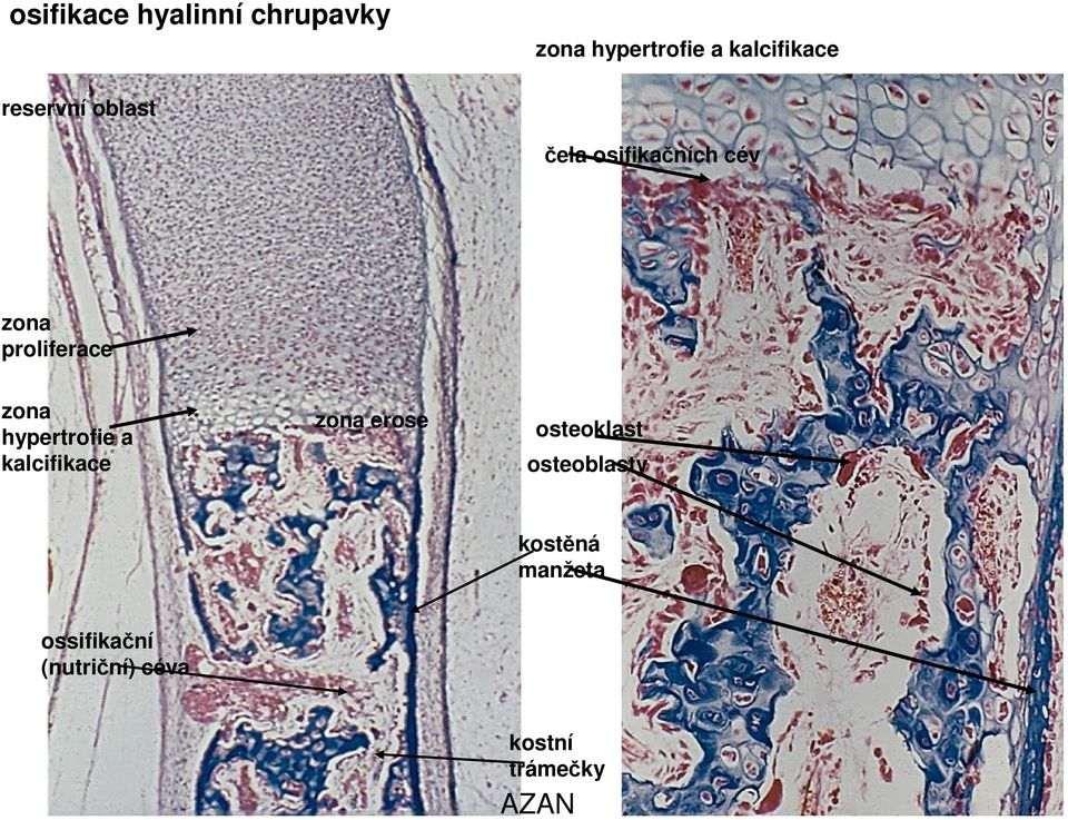 hypertrofie a kalcifikace zona erose osteoklast osteoblasty