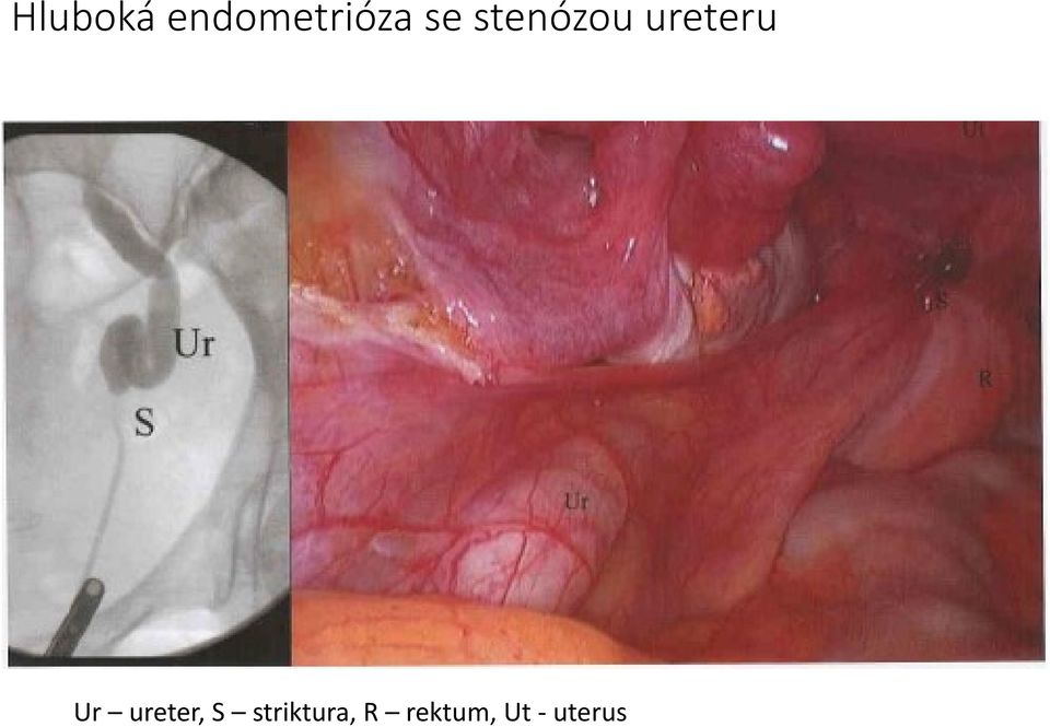 Ur ureter, S