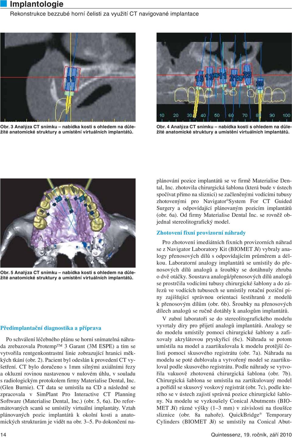 zhotovila chirurgická šablona (která bude v ústech spočívat přímo na sliznici) se začleněnými vodícími tubusy zhotovenými pro Naviga tor System For CT Guided Surgery a odpovídající plánovaným pozicím