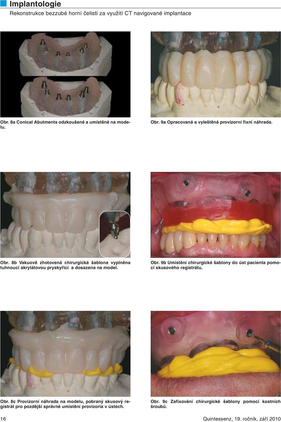 8b Vakuově zhotovená chirurgická šablona vyplněna tuhnoucí akrylátovou pryskyřicí a dosazena na model. Obr.