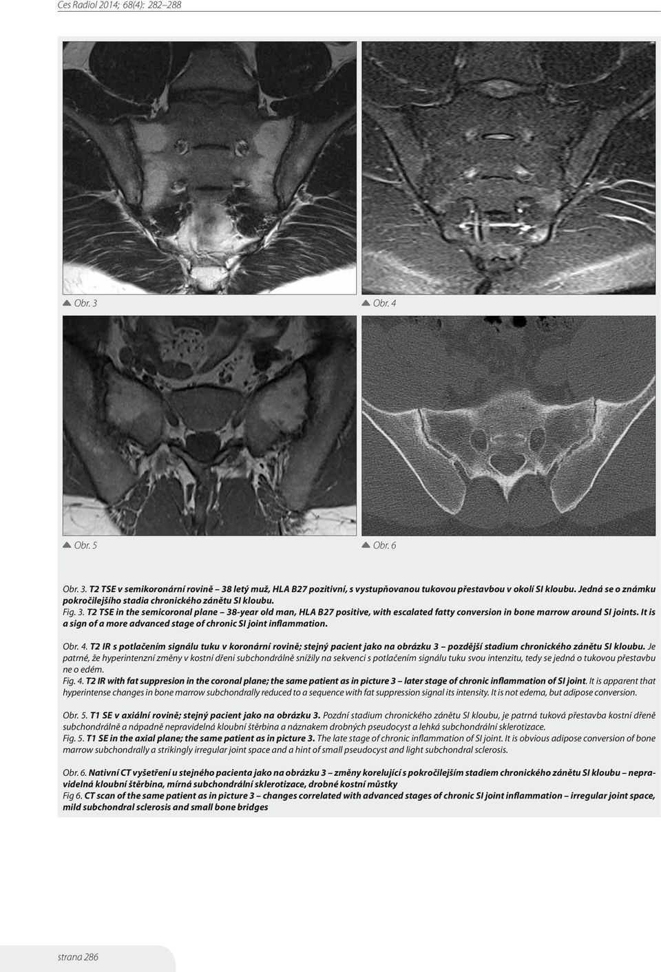 T2 TSE in the semicoronal plane 38-year old man, HLA B27 positive, with escalated fatty conversion in bone marrow around SI joints.