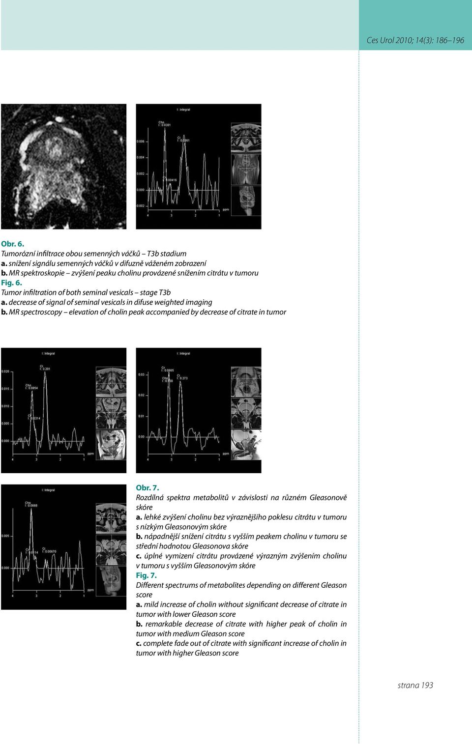 decrease of signal of seminal vesicals in difuse weighted imaging b. MR spectroscopy elevation of cholin peak accompanied by decrease of citrate in tumor Obr. 7.