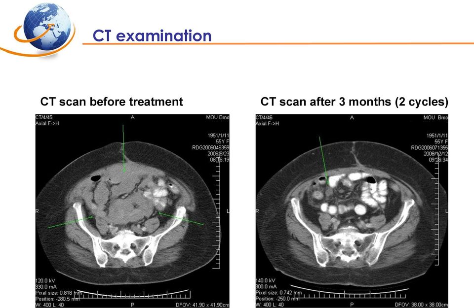 treatment CT scan