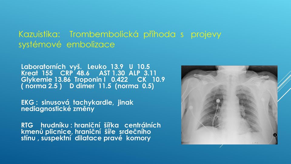 5 ) D dimer 11.5 (norma 0.