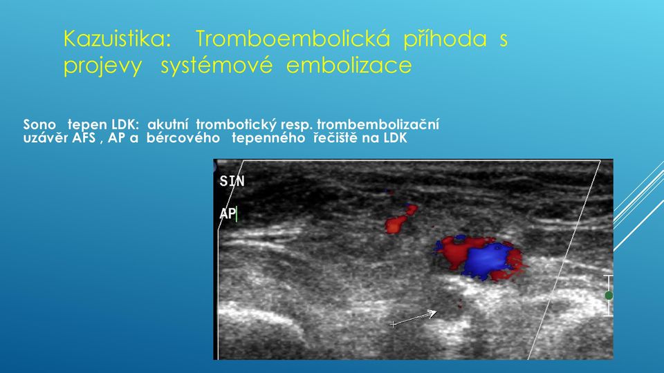 LDK: akutní trombotický resp.