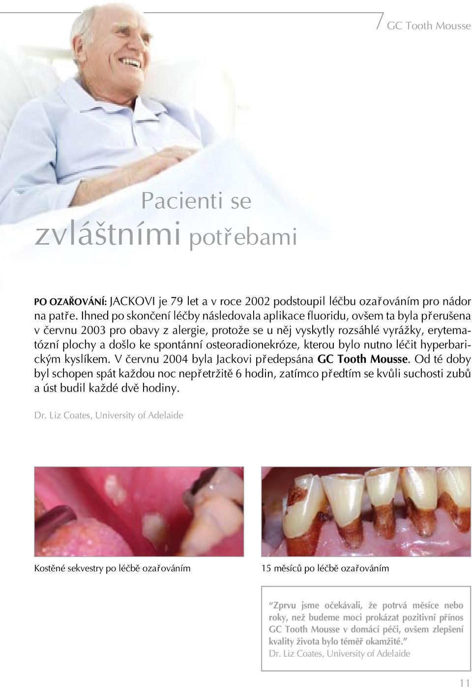 osteoradionekróze, kterou bylo nutno léëit hyperbarickým kyslíkem. V Ëervnu 2004 byla Jackovi p edepsána GC Tooth Mousse.