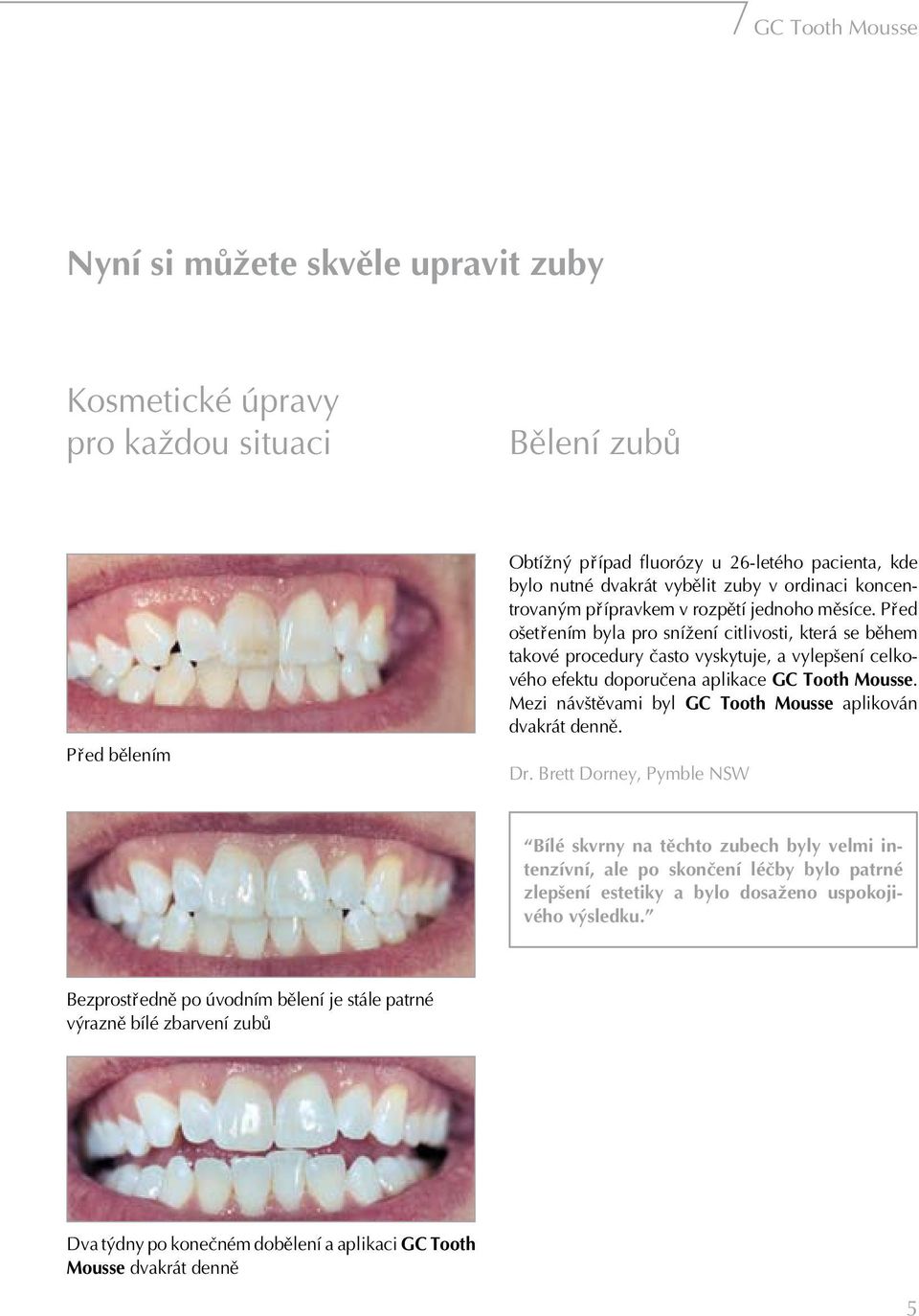P ed oπet ením byla pro sníæení citlivosti, která se bëhem takové procedury Ëasto vyskytuje, a vylepπení celkového efektu doporuëena aplikace GC Tooth Mousse.