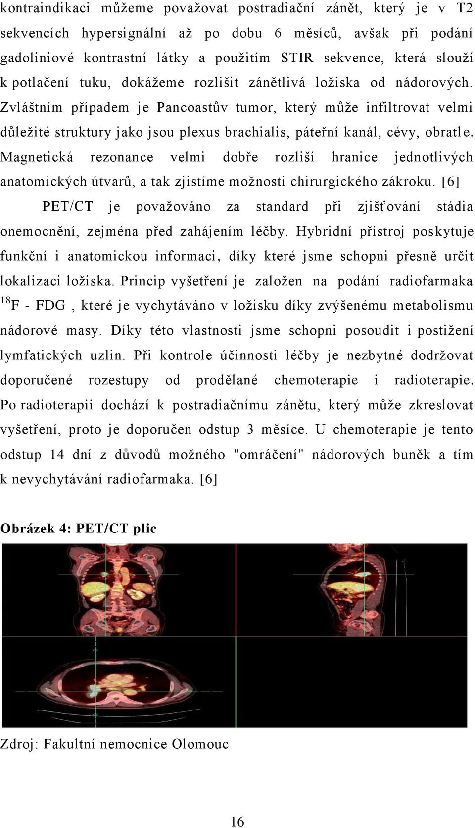 Zvláštním případem je Pancoastův tumor, který může infiltrovat velmi důležité struktury jako jsou plexus brachialis, páteřní kanál, cévy, obratl e.