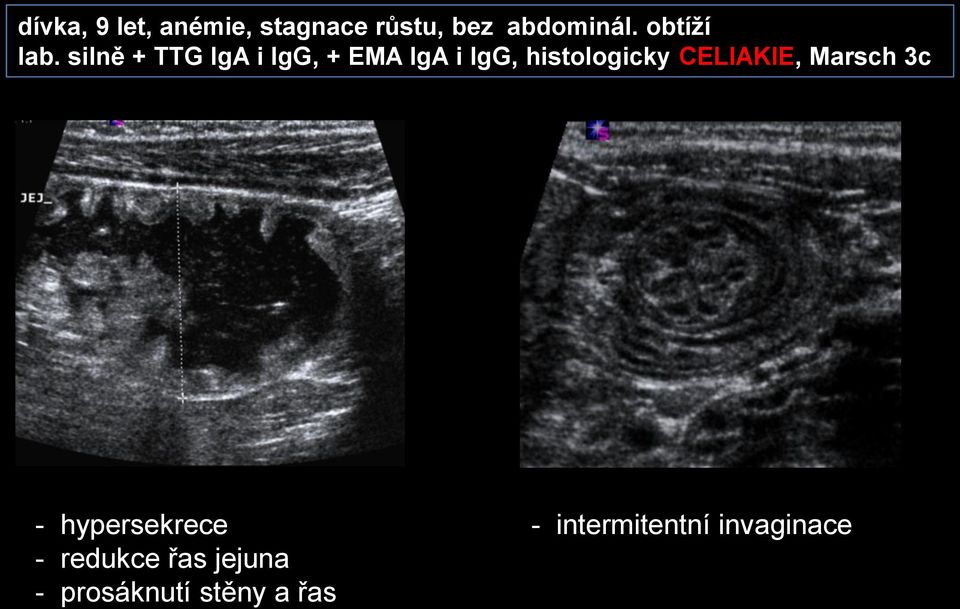 silně + TTG IgA i IgG, + EMA IgA i IgG, histologicky