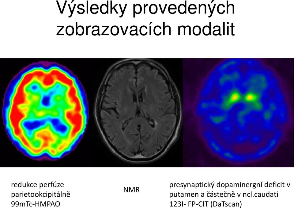 NMR presynaptický dopaminergní deficit v